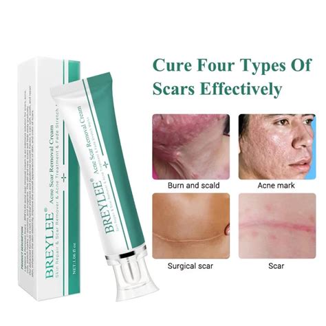 Acne Scar Removal Cream 30g Face Cream Skin Repair Skin Care Scar Acne Treatment Remove Stretch ...