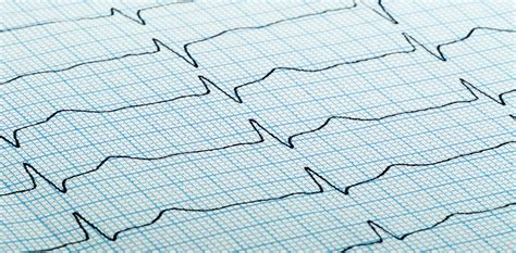 Office ECG | Cardiovascular Medical Group of Southern California