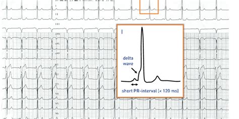 Short PR-interval and ventricular pre-excitation | Cardiocases