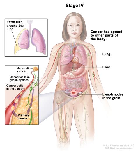 Treatment of Ovarian Epithelial, Fallopian, & Peritoneal Cancers - NCI