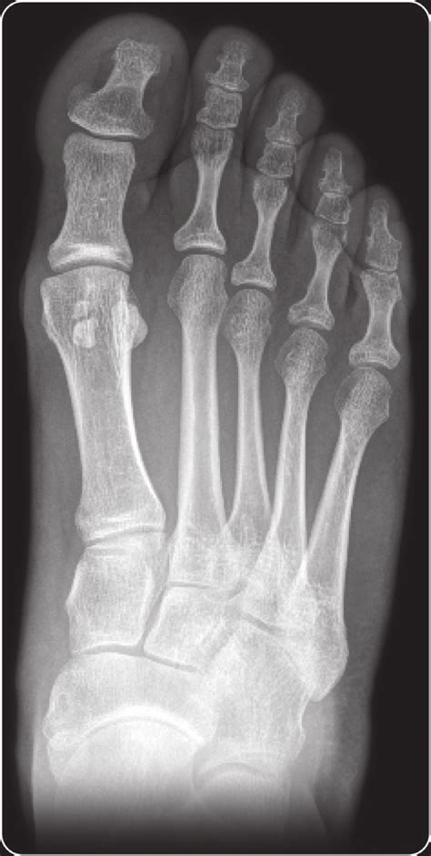 AP X-ray. Moderate hallux valgus. | Download Scientific Diagram