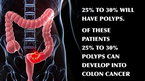 What are polyps in the colon and can they develop into cancer? - YouTube