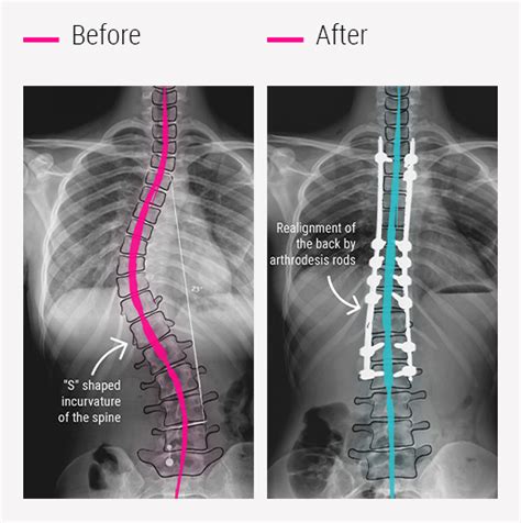 Scoliosis Surgery - CCV Montpellier