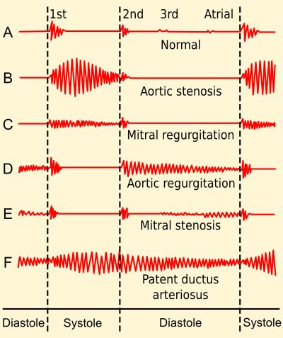 Systolic heart murmur - Wikipedia