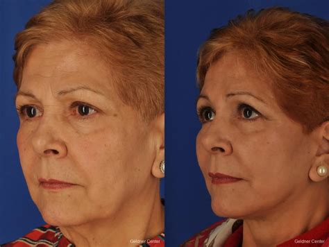 SMAS Facelift Before & After Gallery: Patient 2