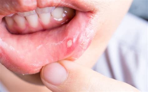 How to Treat and Prevent Cold Sores on Your Lips – News by Nature