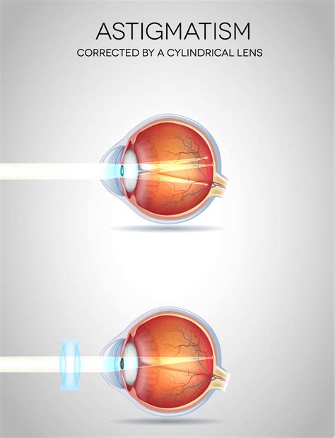 Astigmatism - New Jersey Eye Center