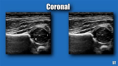 Neonatal Hip Ultrasound – Sonographic Tendencies