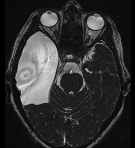 Arachnoid Cyst | Information & Management | Arachnoid Cysts Surgery ...