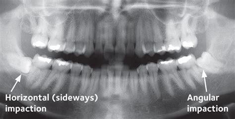 Wisdom Teeth X Ray - TeethWalls