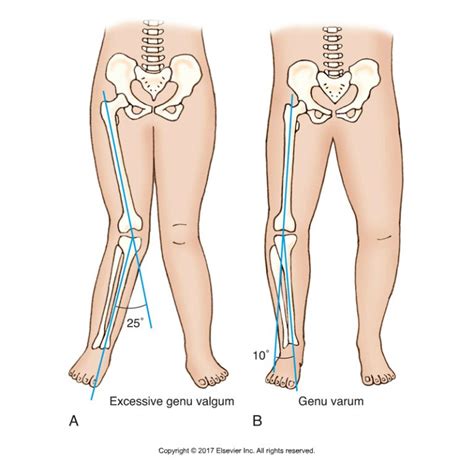 Decreased Ankle Dorsiflexion is Associated with Dynamic Knee Valgus