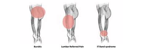 Diagnosing Lateral Thigh Pain: IT band syndrome, Hip Bursitis and referred Back pain - Reid ...