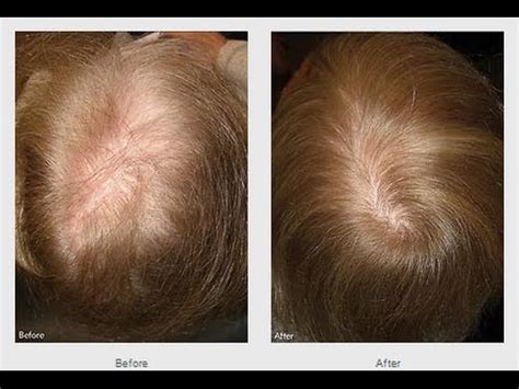 androgenic alopecia treatment - pictures, photos