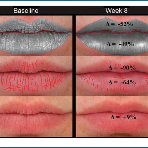 Lip texture of a 51-year-old subject treated with 0.9 mL and 0.55 mL HA... | Download Scientific ...