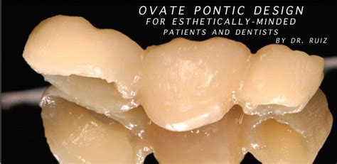 Ovate Pontic Design for Esthetically-Minded Patients and Dentists | Dental Education