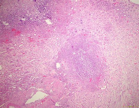 Pathology Outlines - Acute pyelonephritis