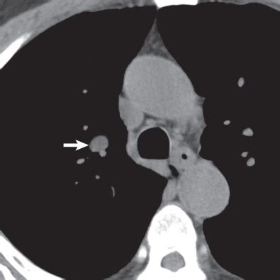 Pulmonary Hamartoma | Radiology Key