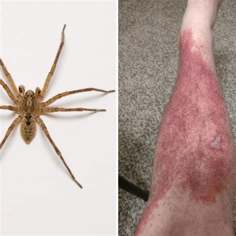 Special Savings brown recluse spider bite