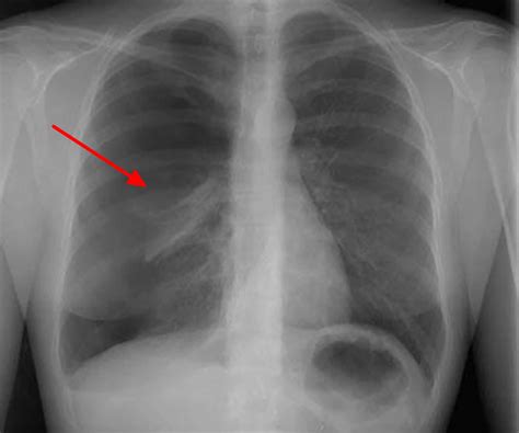 A Pneumothorax Typically Causes - William Hamilton