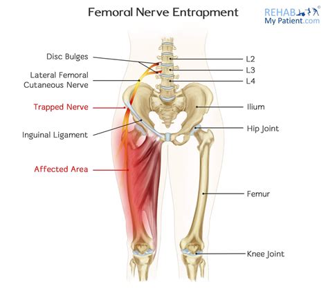 Femoral Nerve Entrapment | Rehab My Patient