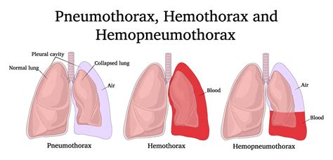 Pneumothorax Physiopedia Shin - Blake Chickie