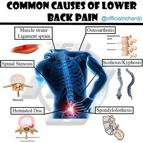 Herniated Disc Lower Right Back Pain