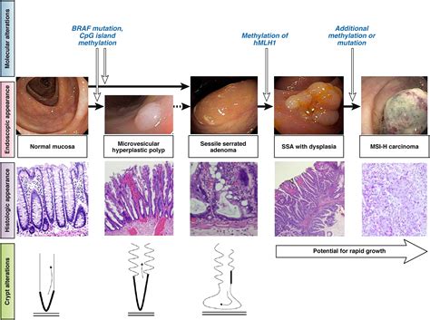 What to do About Sessile Serrated Adenomas – AGA Journals Blog