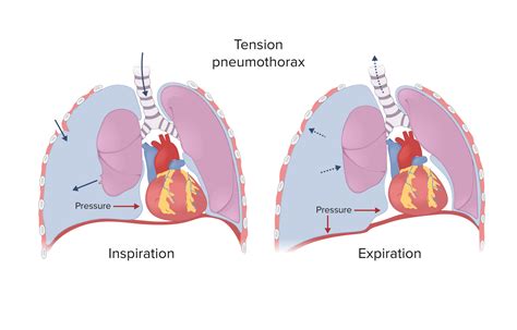 Penetrating Chest Injury | Concise Medical Knowledge