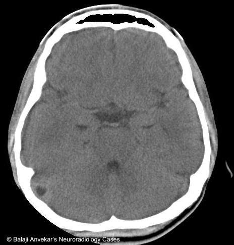 Dr Balaji Anvekar FRCR: Giant Arachnoid granulation