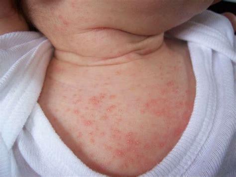 Scabies: Scabies Symptoms & Treatments