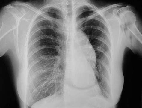 Chest Wall Conditions - Saint John’s Cancer Institute