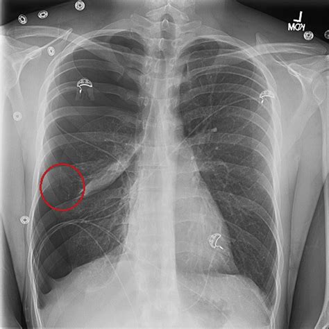 Pneumothorax X Ray : X- Ray Diagnostics Of Pneumothorax: Radiographic ...