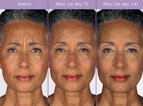 Botox Before After Photos | Wrinkle Remover Dallas, Plano, Texas