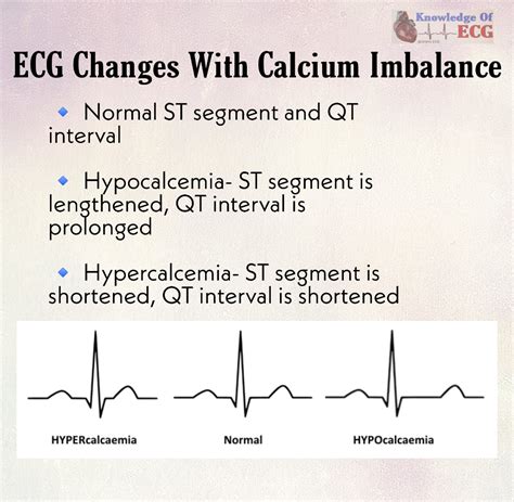 Ecg Changes In Hypocalcemia