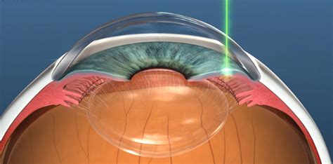 Laser Peripheral Iridotomy - Treat Angle-Closure Glaucoma | Dr Nathan Kerr