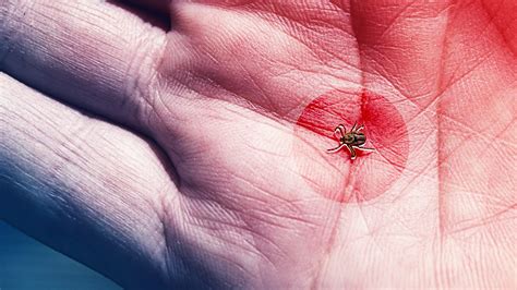 Tick Bite Symptoms You Need to Watch Out For This Summer