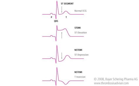 What is NSTEMI? What You NEED to Know • MyHeart