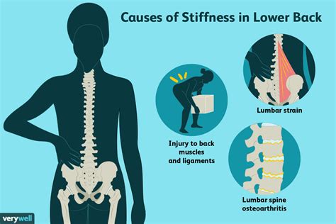 Causes of severe lower back pain