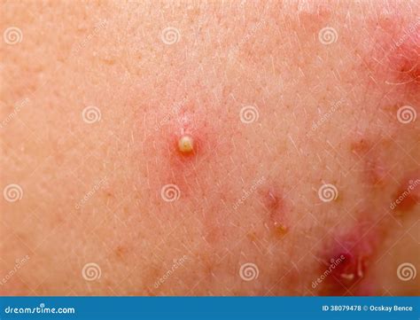 Acne Skin Royalty Free Stock Photos - Image: 38079478