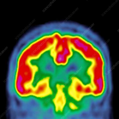 Normal brain activity, PET scan - Stock Image - C026/7608 - Science Photo Library