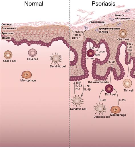 Normal skin and psoriatic plaque histology. This figure juxtaposes ...