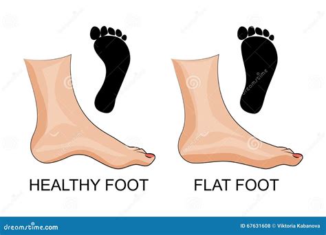 Feet Healthy and Flat Feet. Footprint Stock Vector - Illustration of human, extremity: 67631608