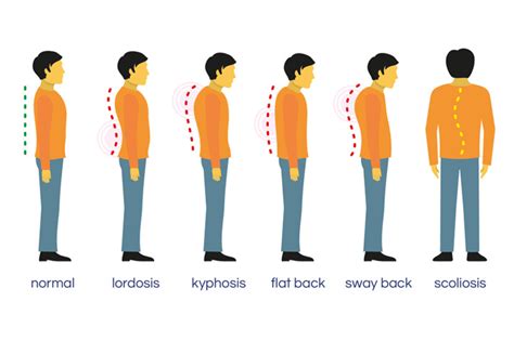 Swayback Lordosis