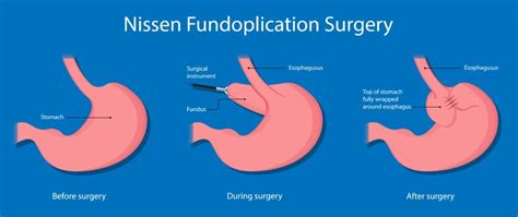 Nissen Fundoplication Weight Loss | Blog Dandk