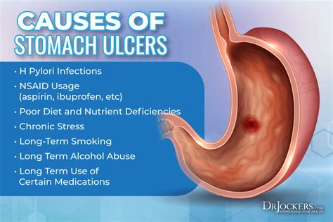 Stomach Ulcers: Causes and Natural Support Strategies - DrJockers.com