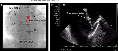 Figure 1 from Visibility of Pulmonary Valve and Pulmonary Regurgitation on Intracardiac ...