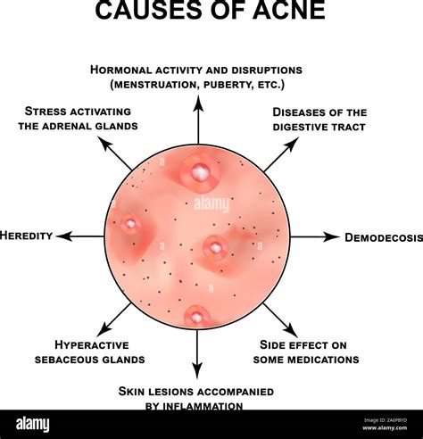 Acne Causes