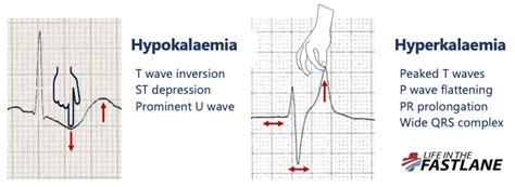 ECG Case 027 • LITFL • ECG Top 100 Self-Assessment Quiz