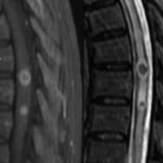 Magnetic resonance imaging (MrI) scan of the sagittal spinal cord... | Download Scientific Diagram