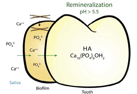 The Delicate Balance of Remineralization and Demineralization - Decisions in Dentistry